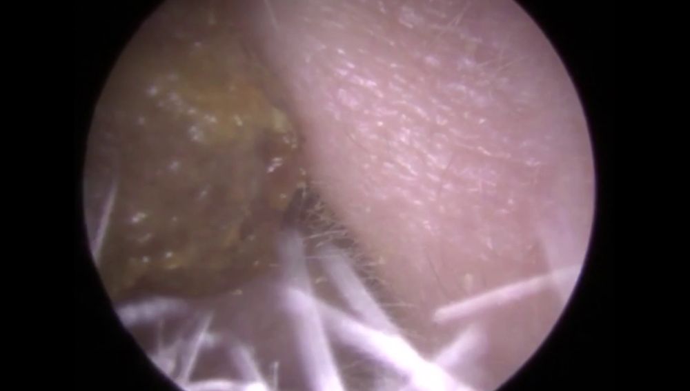 Como sacar tapon de cerumen del oido