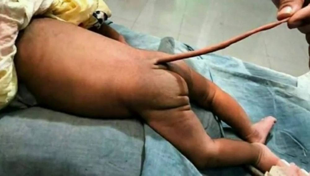 Nace un bebé con 'cola de rata' en Colombia