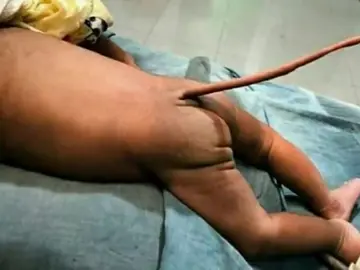 Nace un bebé con 'cola de rata' en Colombia Nace un bebé con 'cola de rata' en Colombia