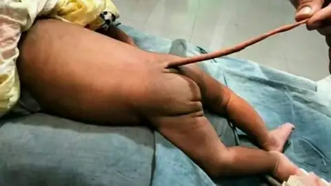 Nace un bebé con 'cola de rata' en Colombia Nace un bebé con 'cola de rata' en Colombia