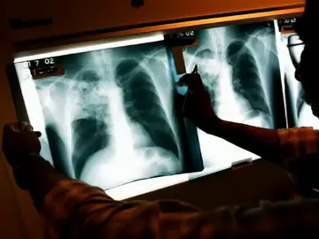 Un hombre se traga su dentadura postiza en una operación y se da cuenta ocho días más tarde Un hombre se traga su dentadura postiza en una operación y se da cuenta ocho días más tarde