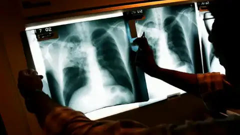 Un hombre se traga su dentadura postiza en una operación y se da cuenta ocho días más tarde Un hombre se traga su dentadura postiza en una operación y se da cuenta ocho días más tarde