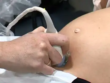 Seis mujeres abortan por el brote de listeria Seis mujeres abortan por el brote de listeria