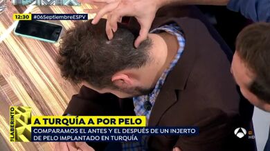 Un periodista de 'Espejo Público' se somete a un implante de pelo en Turquía, ¿cómo ha sido el resultado?