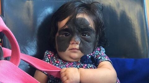 La peque&ntilde;a con el 'lunar' gigante