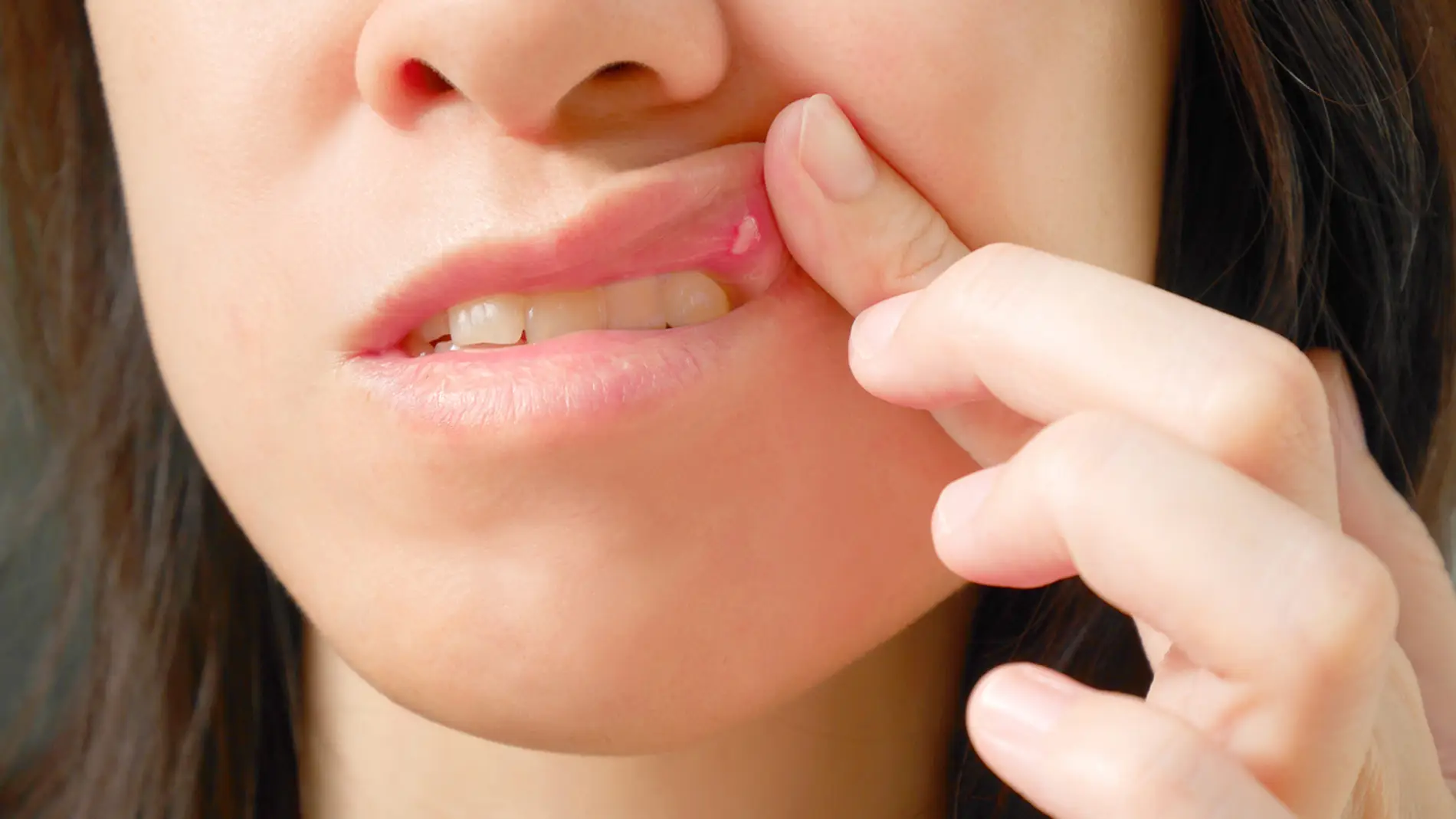 Remedios combatir las llagas en la boca