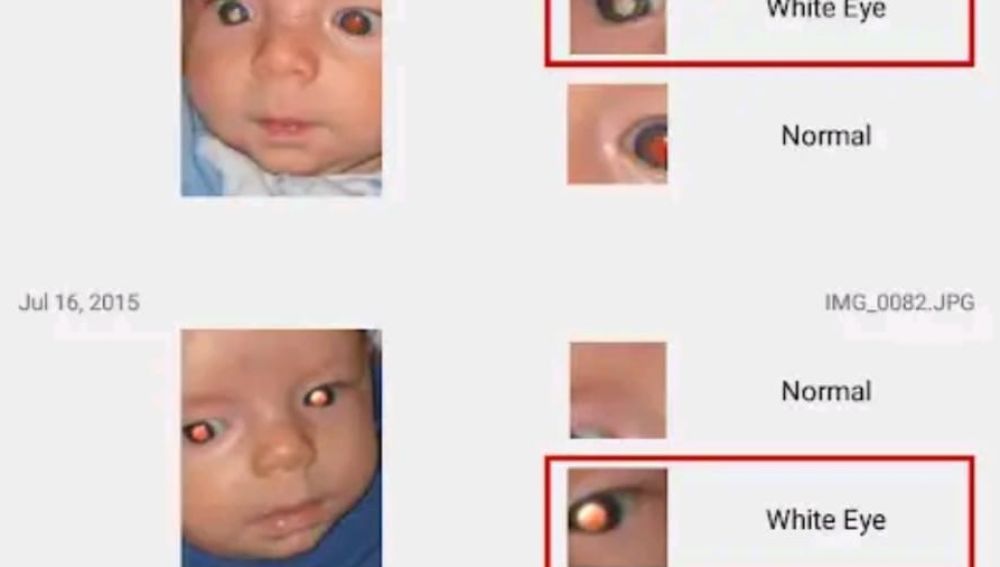 App que detecta enfermedades oculares