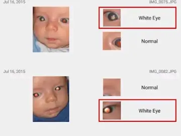 App que detecta enfermedades oculares App que detecta enfermedades oculares
