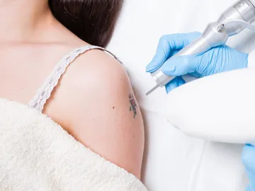 Eliminar un tatuaje Eliminar un tatuaje