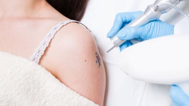 Cosas que deberías saber antes de quitarte un tatuaje