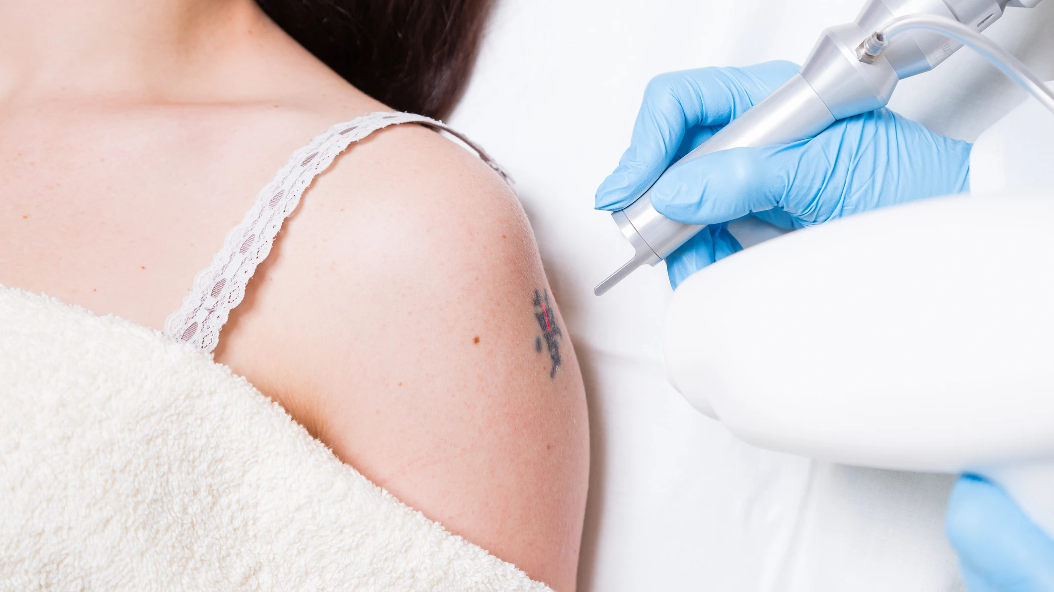 Eliminar un tatuaje Nova Life