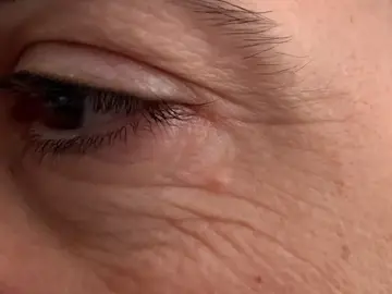 ¿Bótox o ácido hialurónico? Con esto saldrás de dudas ¿Bótox o ácido hialurónico? Con esto saldrás de dudas