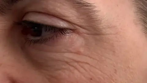 ¿Bótox o ácido hialurónico? Con esto saldrás de dudas ¿Bótox o ácido hialurónico? Con esto saldrás de dudas