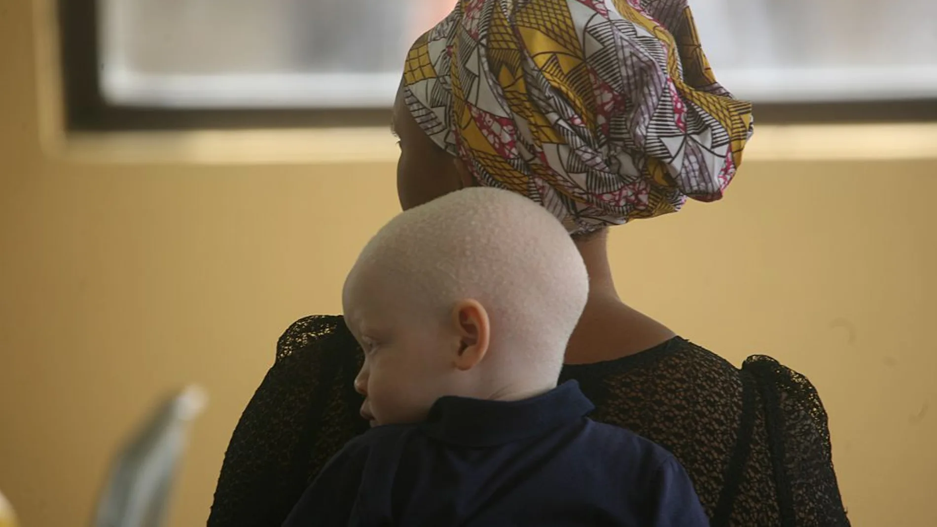 Un niño albino en África Un niño albino en África