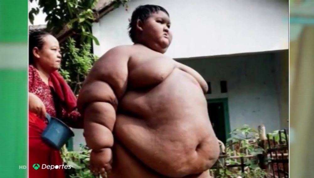 El impactante cambio físico del 'niño más obeso del mundo' que llegó a pesar 200 kilos
