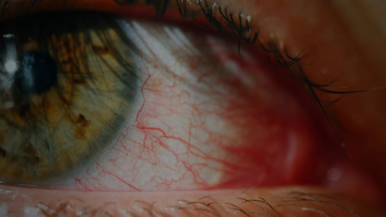 Cómo evitar los ojos rojos con remedios caseros - Antena 3