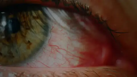 Alivia el enrojecimiento de ojos con estos sencillos trucos Consejos para aliviar el enrojecimiento de ojos