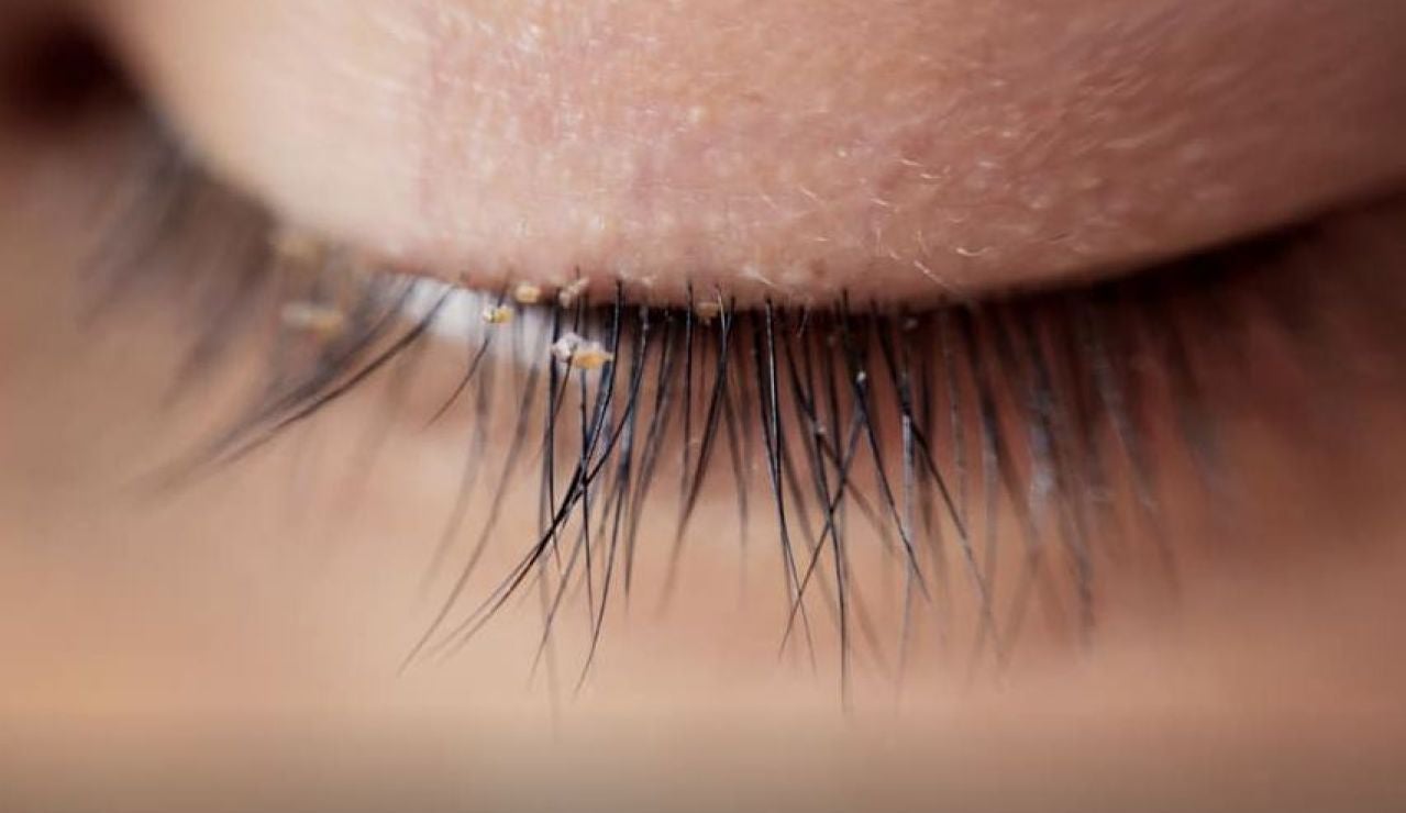 casos de piojos en pestañas