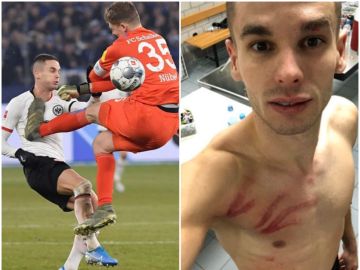 Mijat Gacinovic tras la brutal patada recibida en el partido contra el Schalke 04