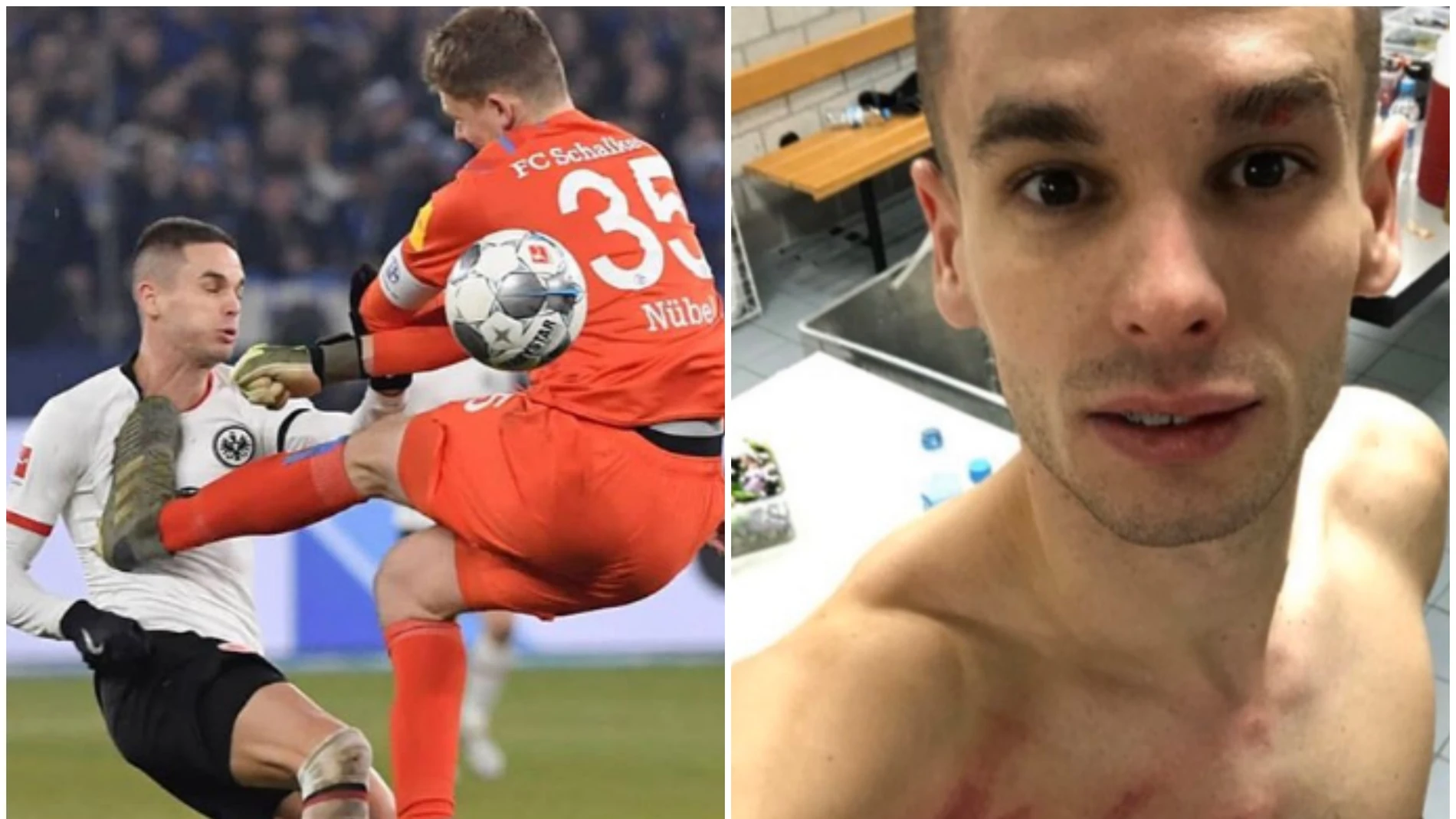 Mijat Gacinovic tras la brutal patada recibida en el partido contra el Schalke 04 Mijat Gacinovic tras la brutal patada recibida en el partido contra el Schalke 04