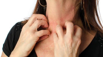 Alergia