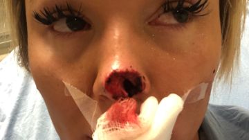 Una mujer se queda sin nariz después de que su ex novio se la arrancase de un mordisco
