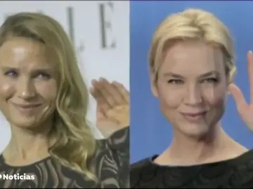 Rinoplastia: ¿Qué tipos de nariz son las más solicitadas? Rinoplastia: ¿Qué tipos de nariz son las más solicitadas?