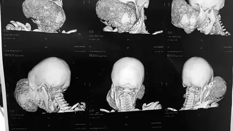 El tumor extirpado al niño de 10 años El tumor extirpado al niño de 10 años