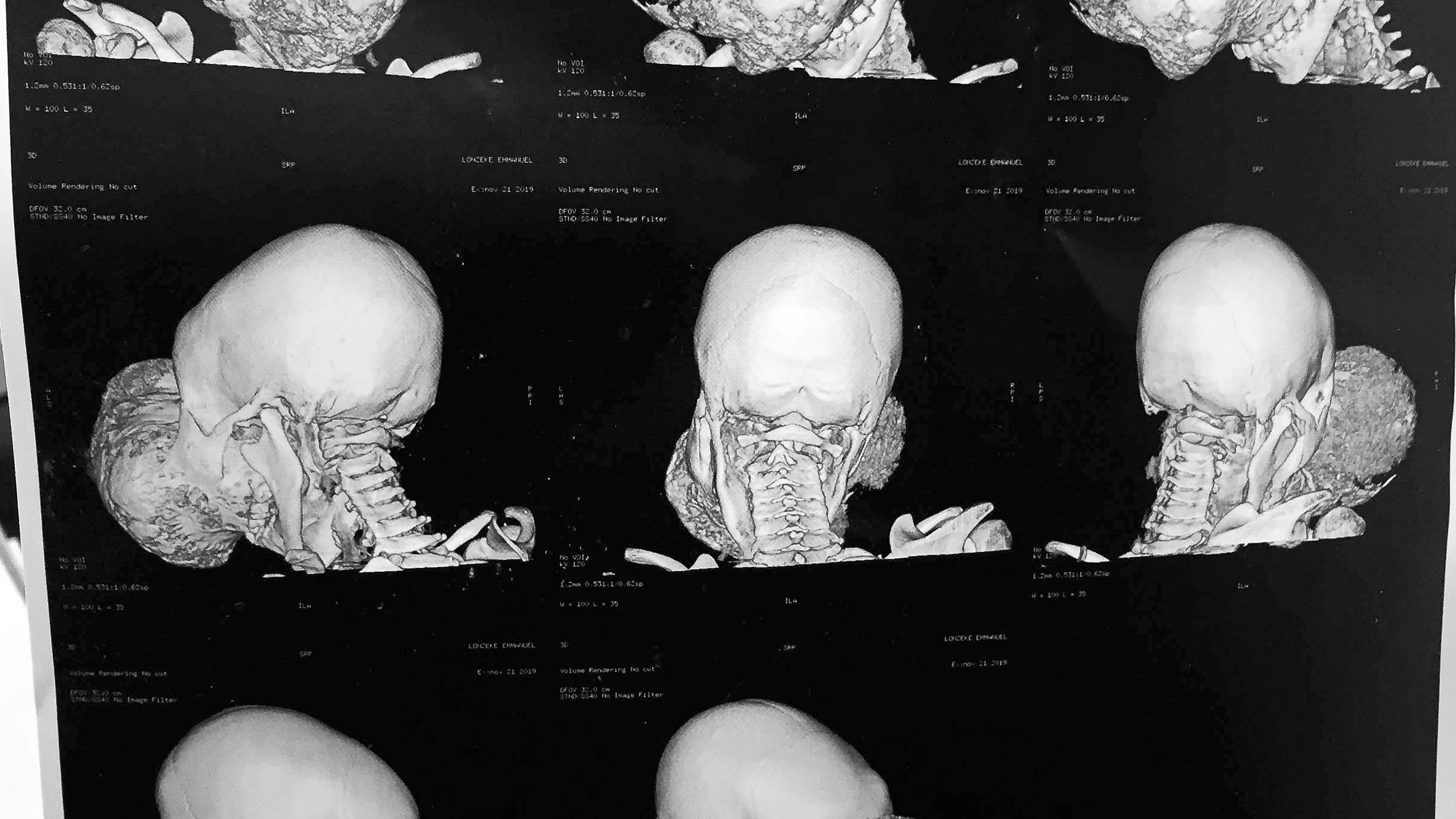 El tumor extirpado al niño de 10 años El tumor extirpado al niño de 10 años