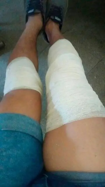 Sufrió quemaduras desde las piernas a las axilas Sufrió quemaduras desde las piernas a las axilas