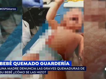 BEBE QUEMADO BEBE QUEMADO