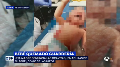 BEBE QUEMADO BEBE QUEMADO