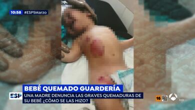 Un bebé sufre quemaduras de segundo grado en la guardería donde argumentan que 