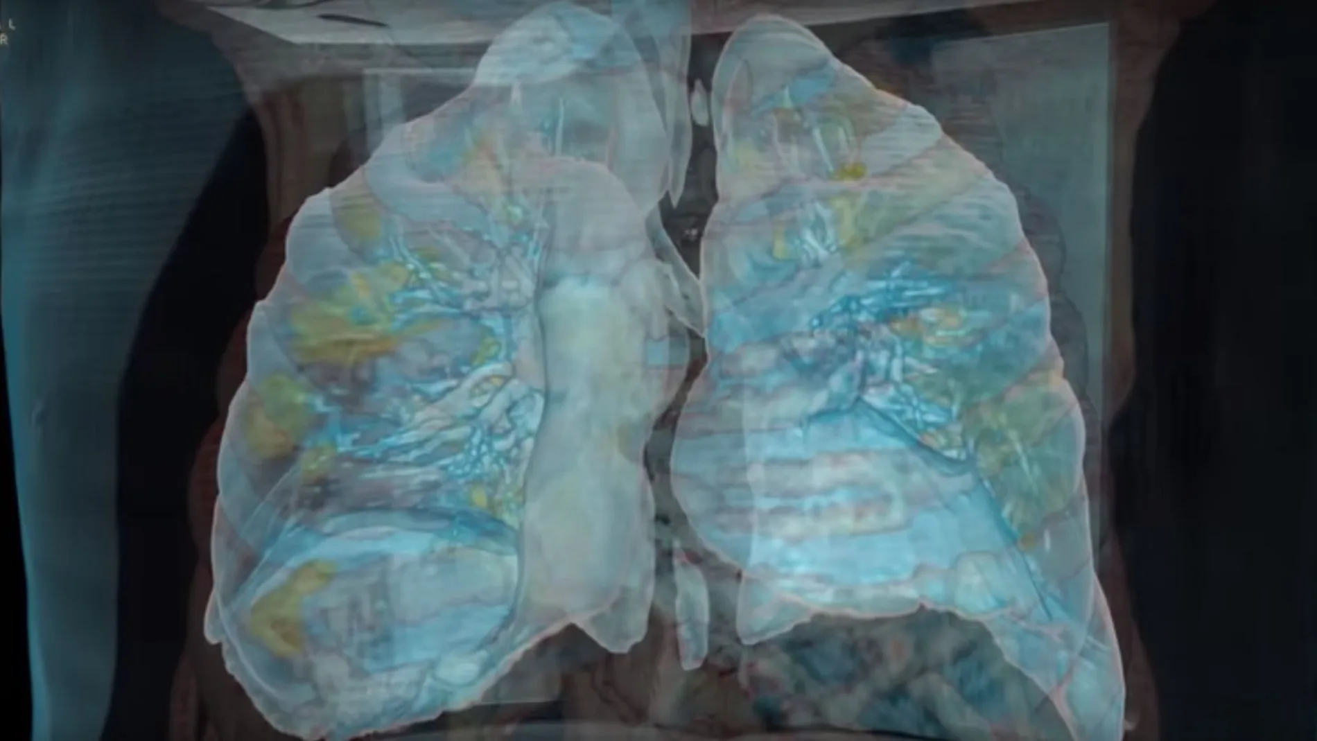 Imagen de unos pulmones afectados por coronavirus (Archivo) Imagen de unos pulmones afectados por coronavirus (Archivo)