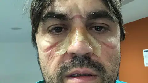 Marcas en la piel de un sanitario de Ourense. Mascarillas coronavirus