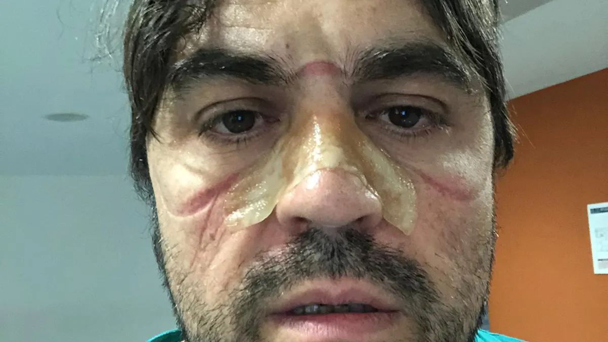 Marcas en la piel de un sanitario de Ourense. Mascarillas coronavirus