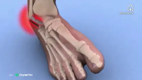 LESIONESCONFIN LESIONESCONFIN