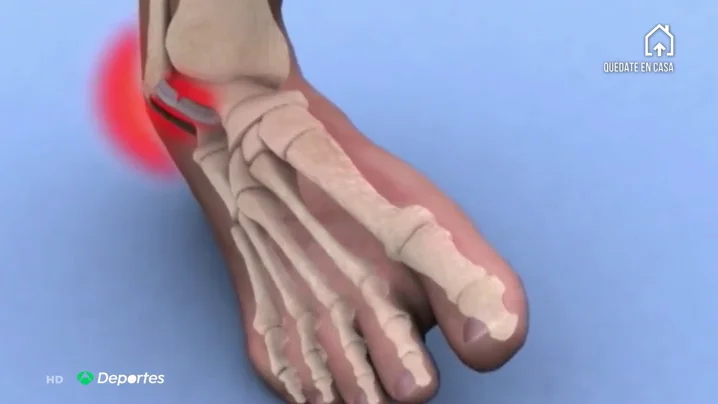LESIONESCONFIN LESIONESCONFIN