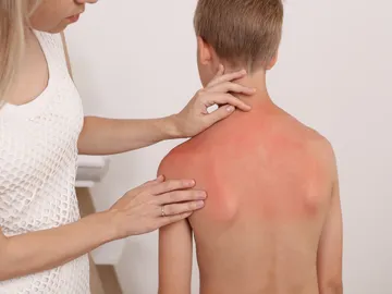 Niño con quemaduras solares Niño con quemaduras solares