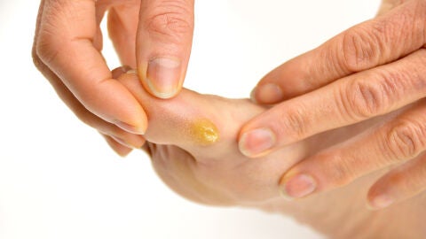 Heridas en los pies