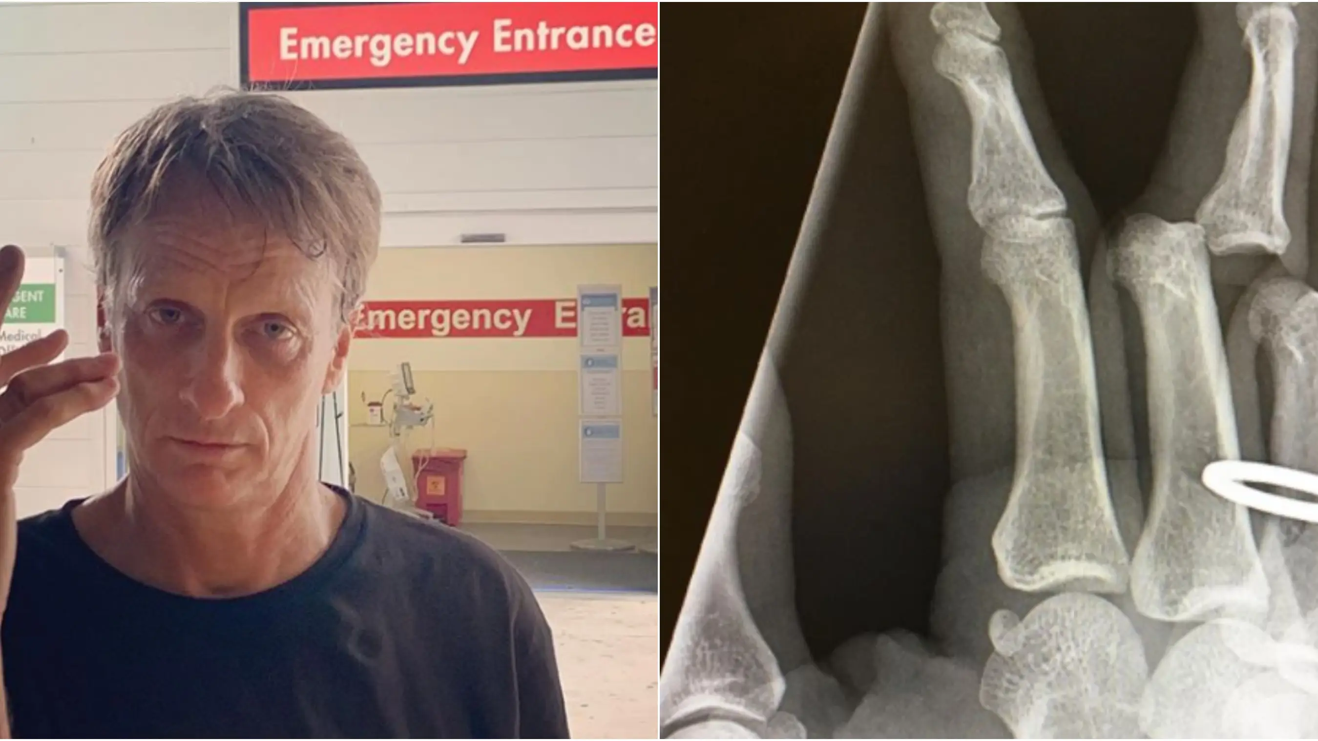 Imagen de la terrible lesi&oacute;n de Tony Hawk