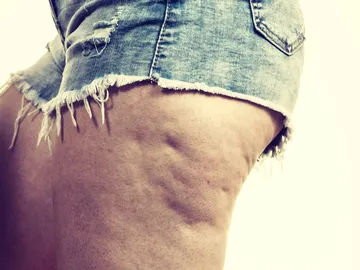Piernas con celulitis en pantalón corto Piernas con celulitis en pantalón corto