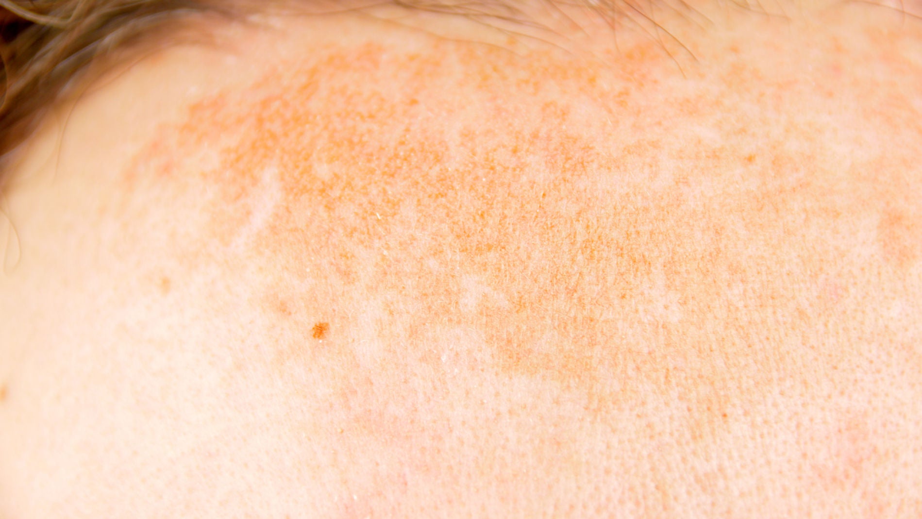 Manchas solares en la cara