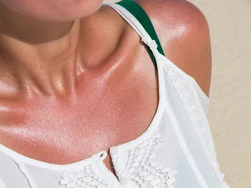 Quemadura solar Quemadura solar