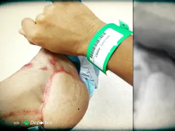 La historia de superación de Mónica Ballús tras un accidente de moto: "Me reconstruyeron un talón XXL" La historia de superación de Mónica Ballús tras un accidente de moto: "Me reconstruyeron un talón XXL"