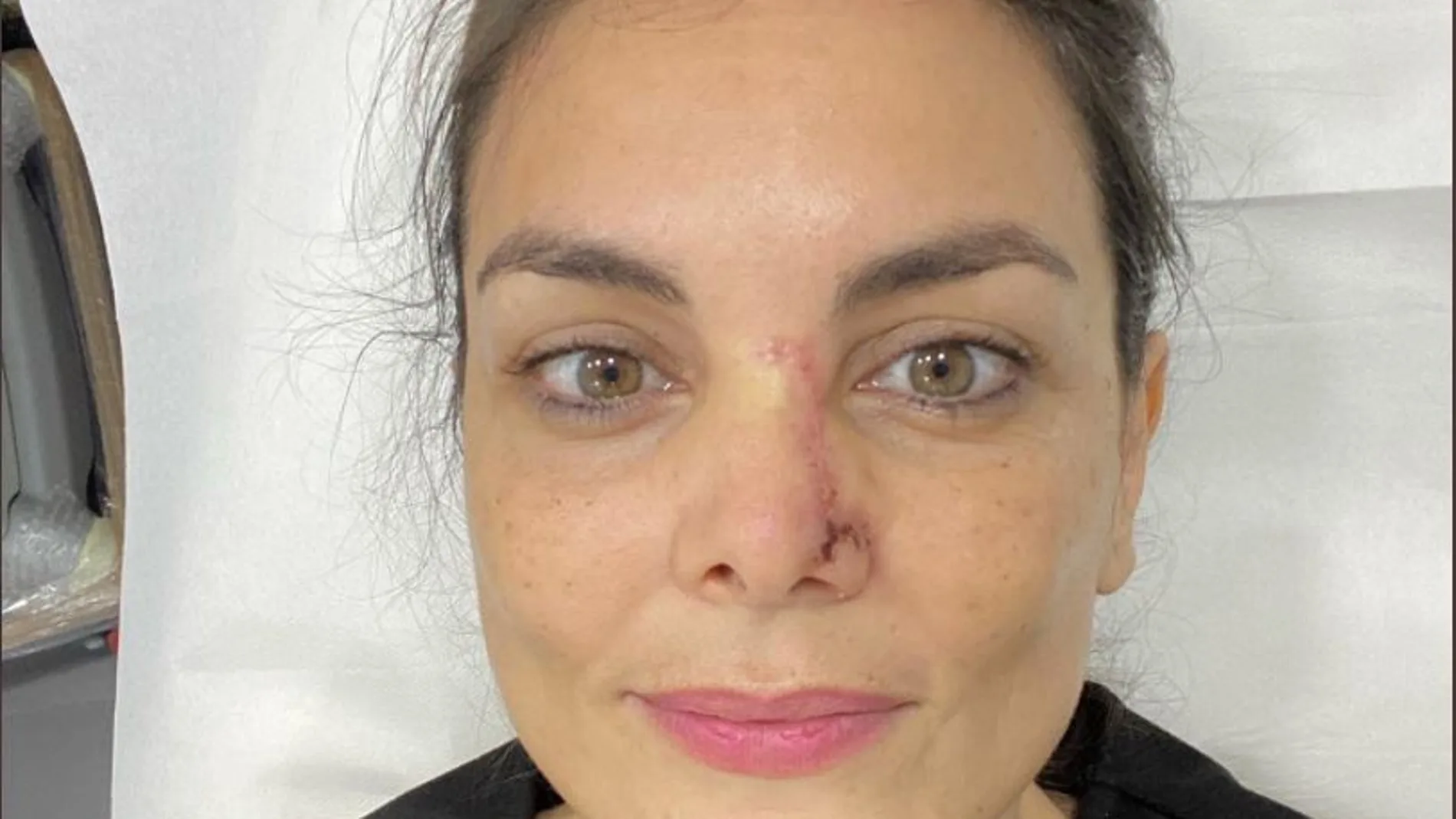 Mónica Carrillo mostrando su proceso de recuperación de un cáncer de piel Mónica Carrillo mostrando su proceso de recuperación de un cáncer de piel