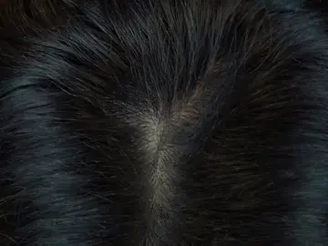 El remedio casero definitivo contra la caspa El remedio casero definitivo contra la caspa