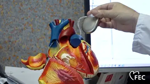 ¿Cómo funciona un desfibrilador implantado? ¿Cómo funciona un desfibrilador implantado?