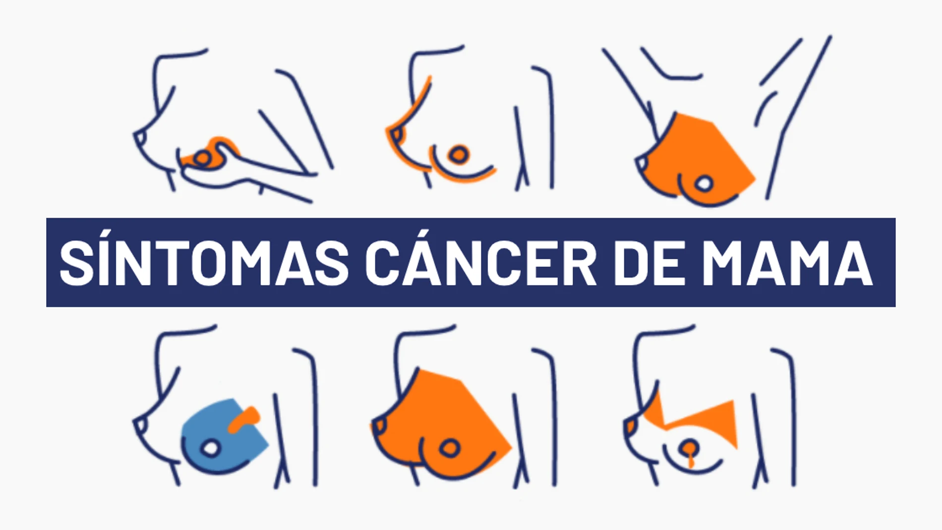 Día del cáncer de mama 2020: 5 síntomas del cáncer de mama para una detección temprana Día del cáncer de mama 2020: 5 síntomas del cáncer de mama para una detección temprana