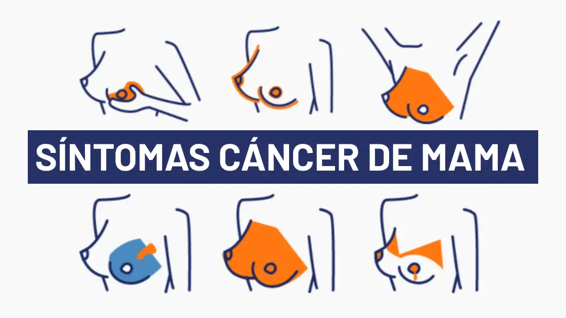 Día del cáncer de mama 2020: 5 síntomas del cáncer de mama para una detección temprana Día del cáncer de mama 2020: 5 síntomas del cáncer de mama para una detección temprana